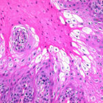 Dane's Method for Prekeratin, Keratin, and Mucin